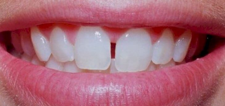 gap between front teeth