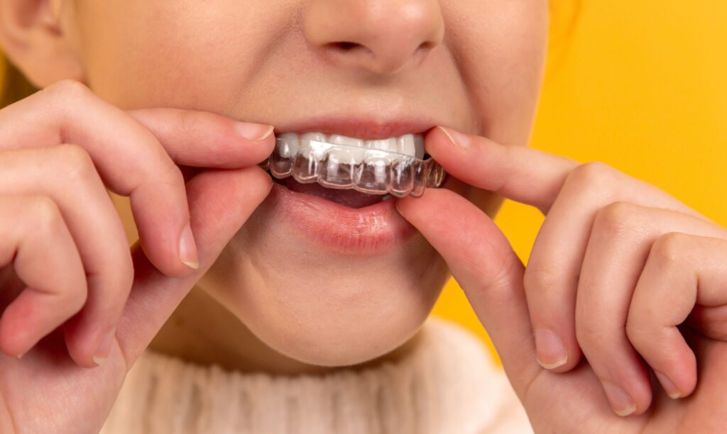 Child wearing invisalign dental aligners.