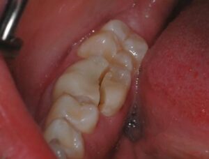 image of cracked tooth in mouth